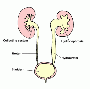 Resim: Sağda normal böbrek ve ureter, solda basıya bağlı idrar akışında zorluk, böbrek ve ureterde genişleme