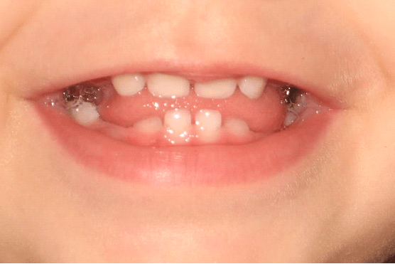Bebeklerde Diş Gelişimi